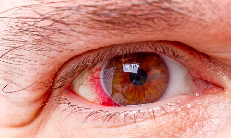 Glaucoma: O que é